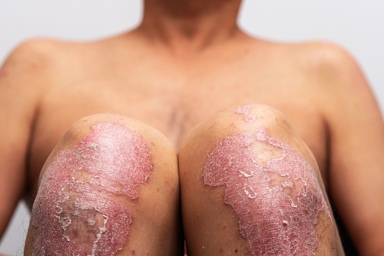 Cómo aliviar la psoriasis